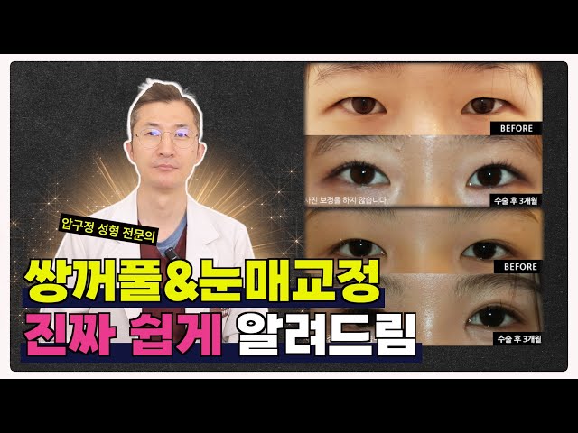 👁️ 쌍꺼풀 + 눈매교정 ✨진짜 쉽게 알려드립니다!