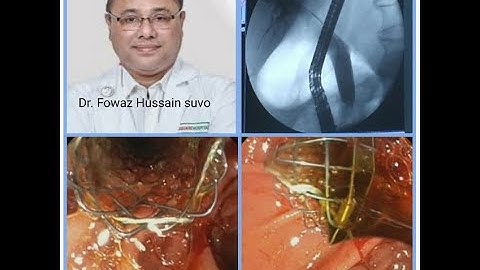 ERCP WITH METAL STENTING OF CBD at SQUARE HOSPITAL LTD by Dr Fowaz Hussain shuvo #BD_ENDOSCOPY