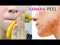 I Rubbed Banana Peels on My Face and Pimples are Gone | Amazing Uses Of Banana Peel