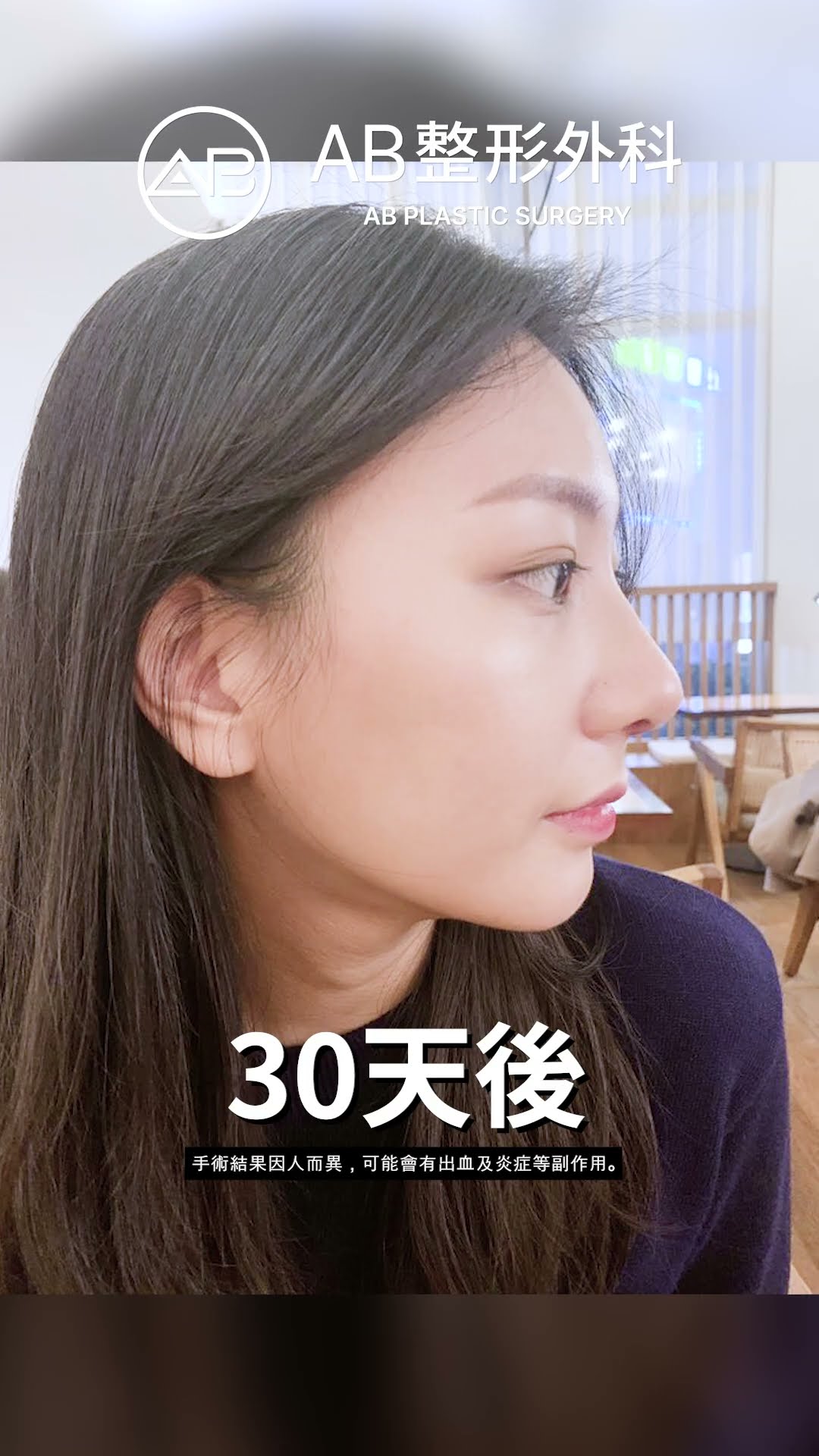 輪廓＋抽脂＋隆鼻術前術後大公開！#热门 #推荐