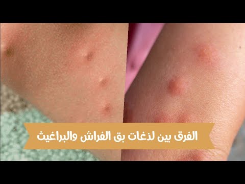 لذغات او قرصات بق الفراش والبراغيث على جسم الانسان
