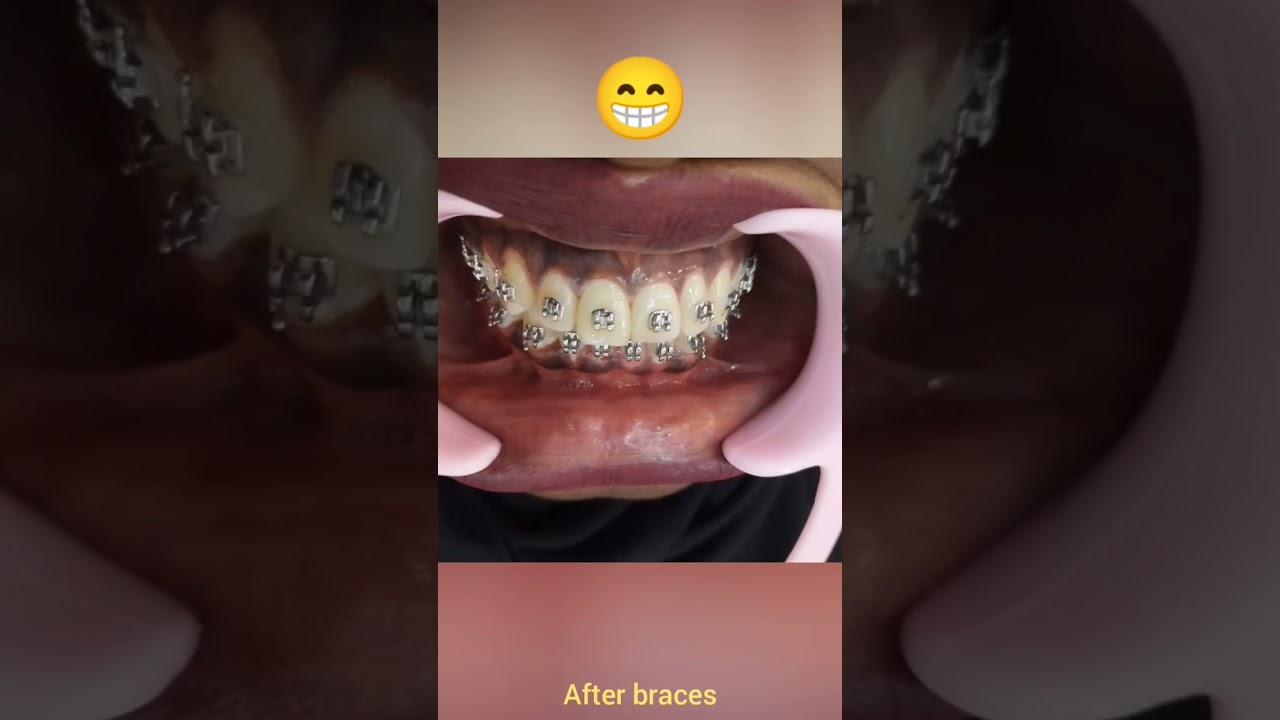 bracesbeforeandafter 