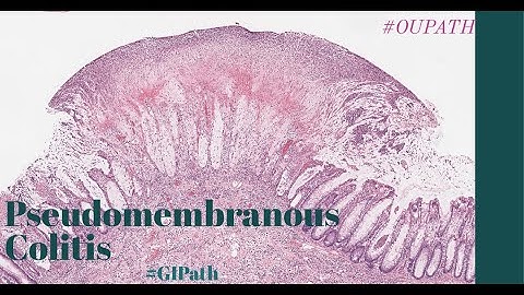 Pseudomembranous colitis