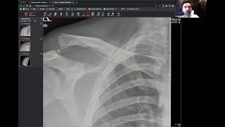 AC Joint Subluxation: The Alignment Everyone Misses on a Shoulder X-Ray!