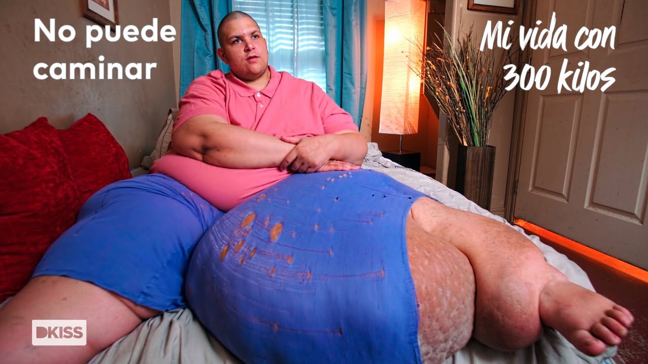 El caso extremo de J.T.: más de 400 kilos y un gran linfedema | Mi vida con 300 kilos