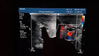 Choledocal Cyst Sonography