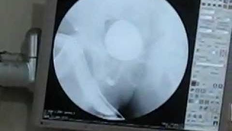 Micturating Cystourethrogram