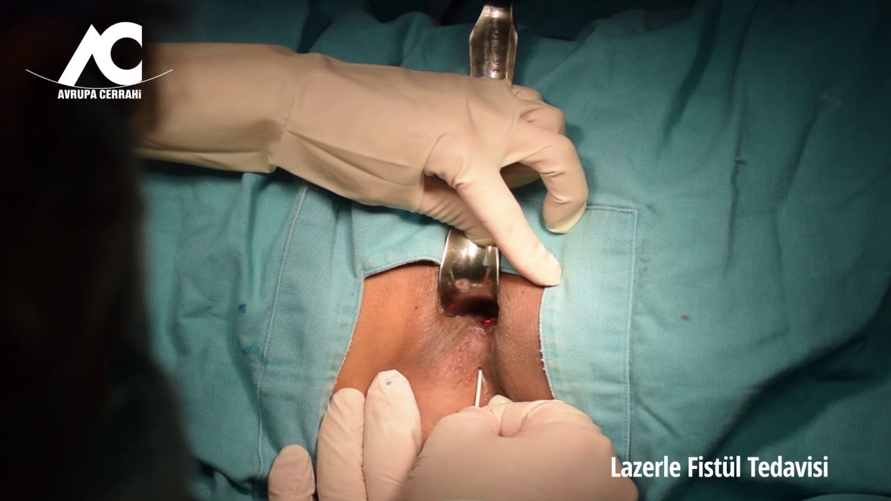 anal fistul anal apse makat apsesi perianal fistul tedavisi proktoloji merkezi