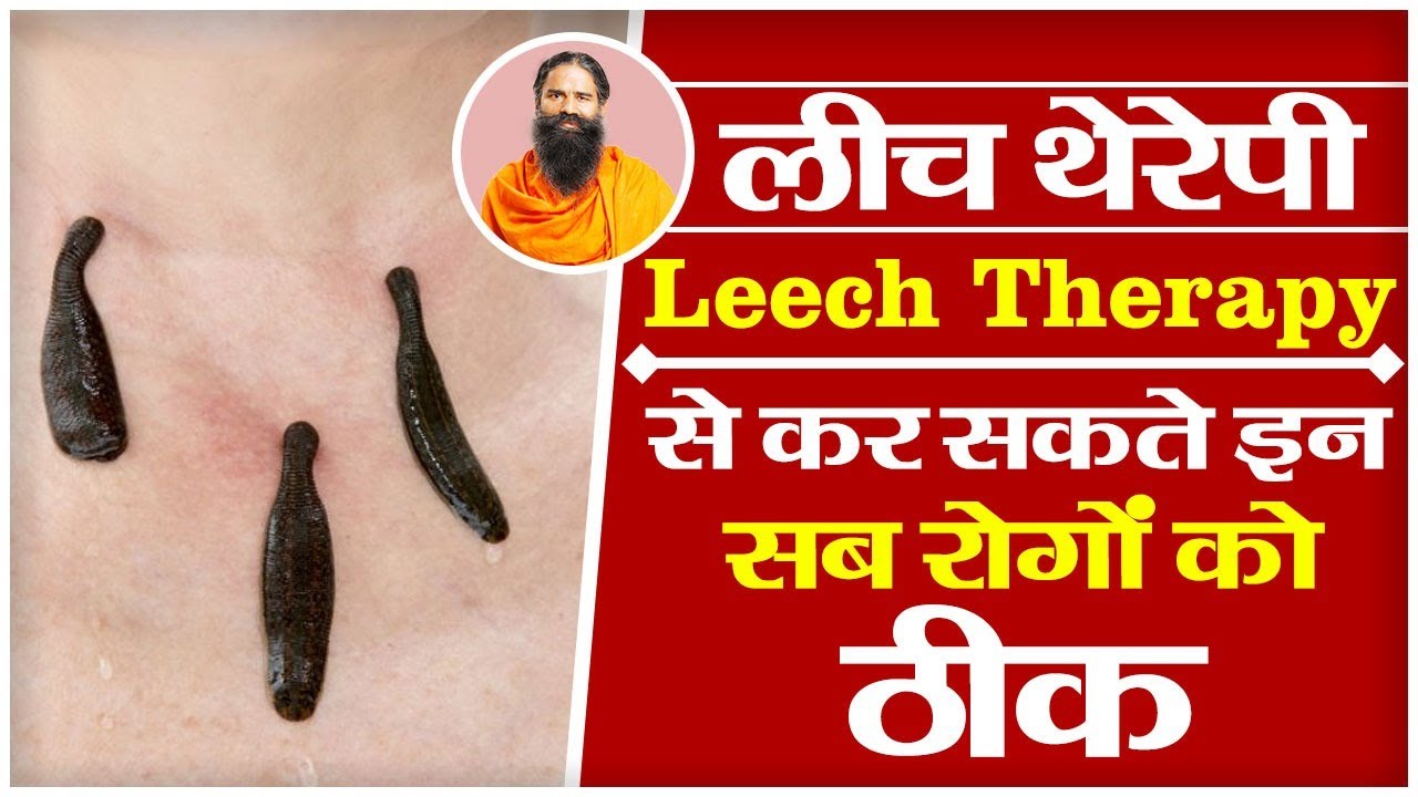 लीच थेरेपी (Leech Therapy) से कर सकते इन सब रोगों को ठीक Swami