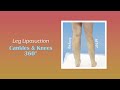 Cankles & Knees Liposuction | Immediate Results | Expert Dr. Thomas Su