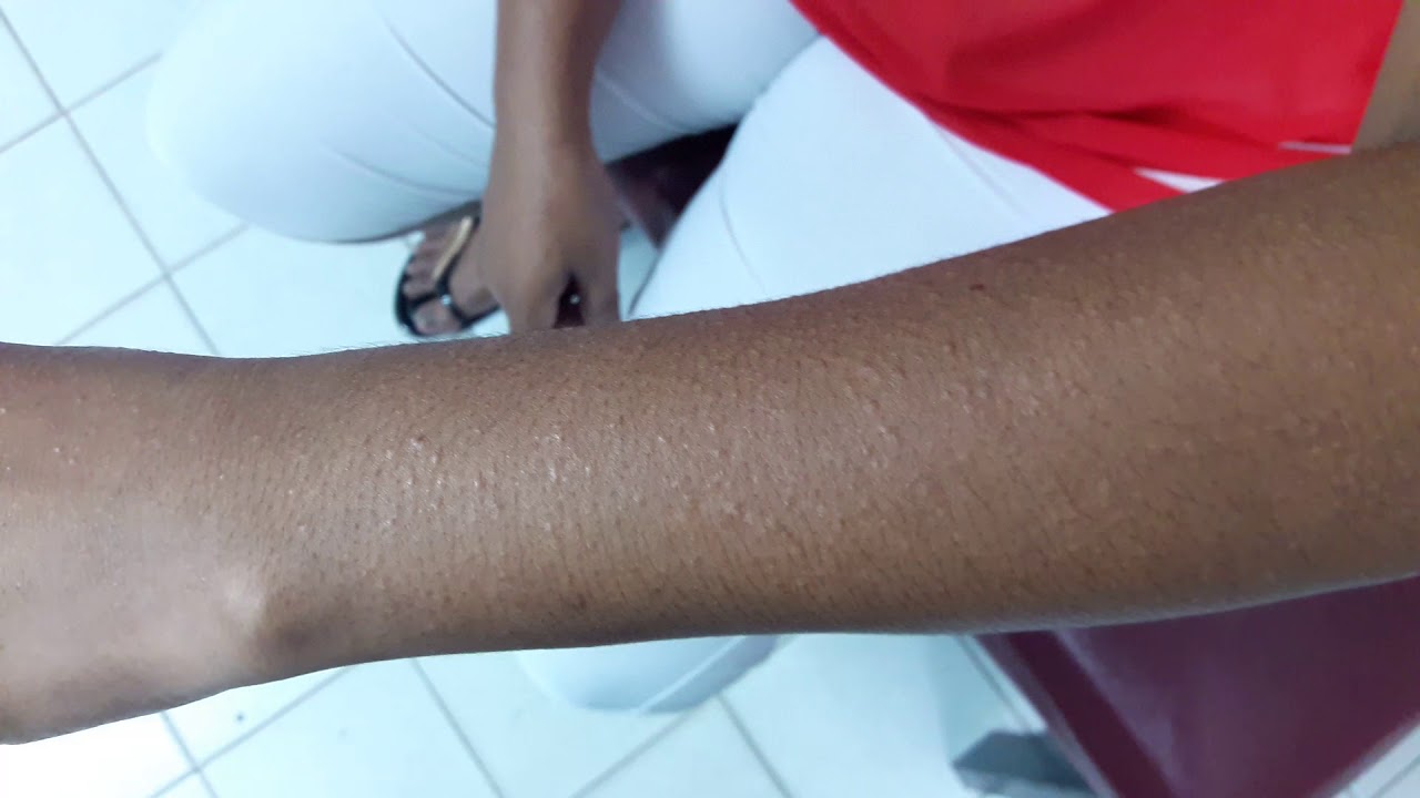 Papular eczema sun exposed areas YouTube