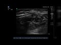 ultrasound guided axillary brachial plexus block