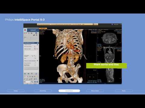 Philips IntelliSpace Portal 9.0, Clinical application CT TAVI planning