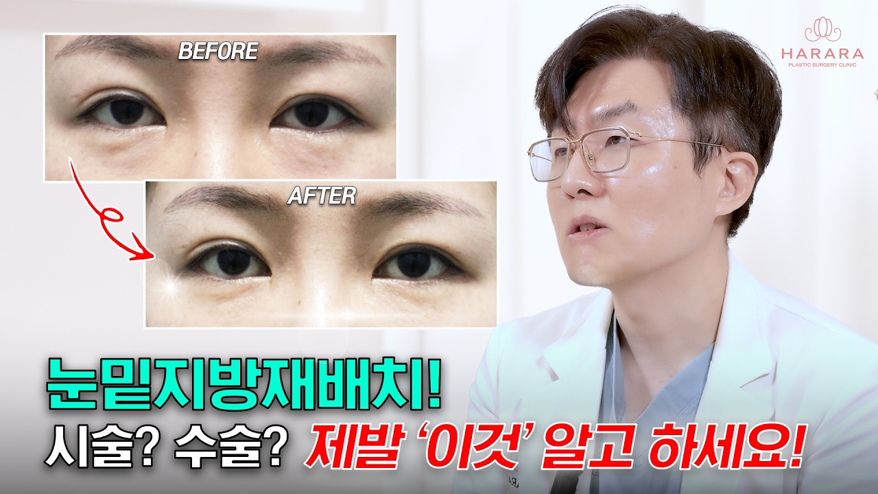 울퉁불퉁한 눈밑 고랑, 심한 눈밑지방, 싹 다 가능합니다.👁️🚫 | 눈밑지방재배치 3편