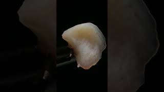 ✨ Técnica de cuña desde tuberosidad ✨La técnica de cuña es una alternativa quirúrgica
