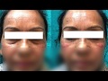 Tear trough deformity correction  by Dr Jangid at SkinQure