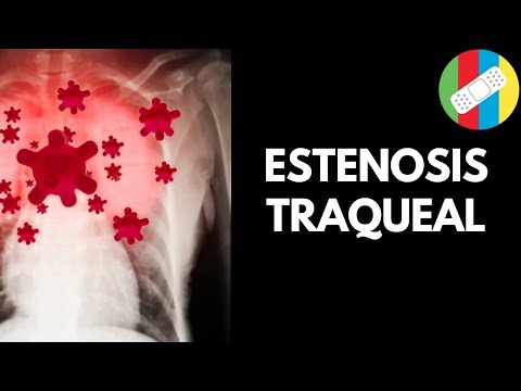 Vídeo: Estenosis Laríngea Crónica: Causas, Síntomas, Tratamiento Y Consecuencias