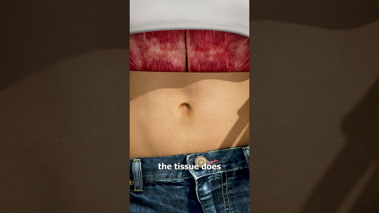 What Causes An Outie Belly Button 