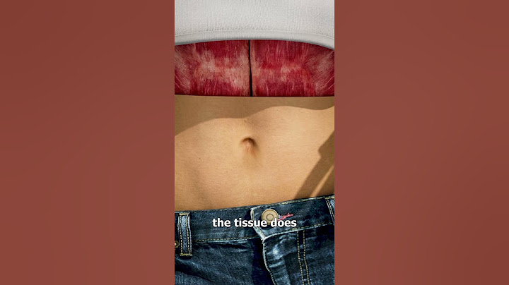 What Causes An Outie Belly Button? 🤔