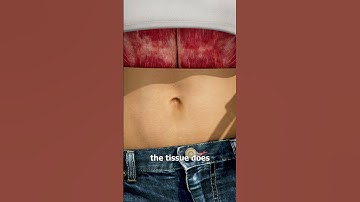 What Causes An Outie Belly Button? 🤔