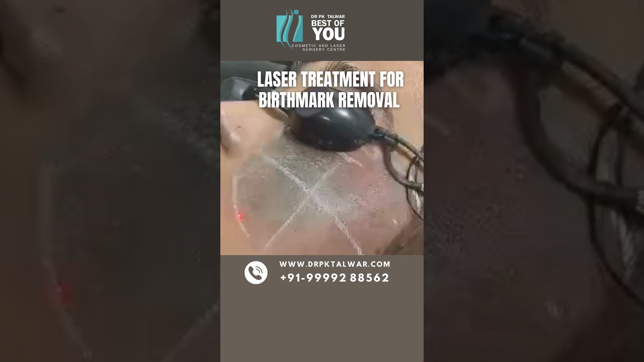 Laser Treatment for Birthmark Removal| Birthmark Removal Treatment in Delhi | Dr. PK Talwar