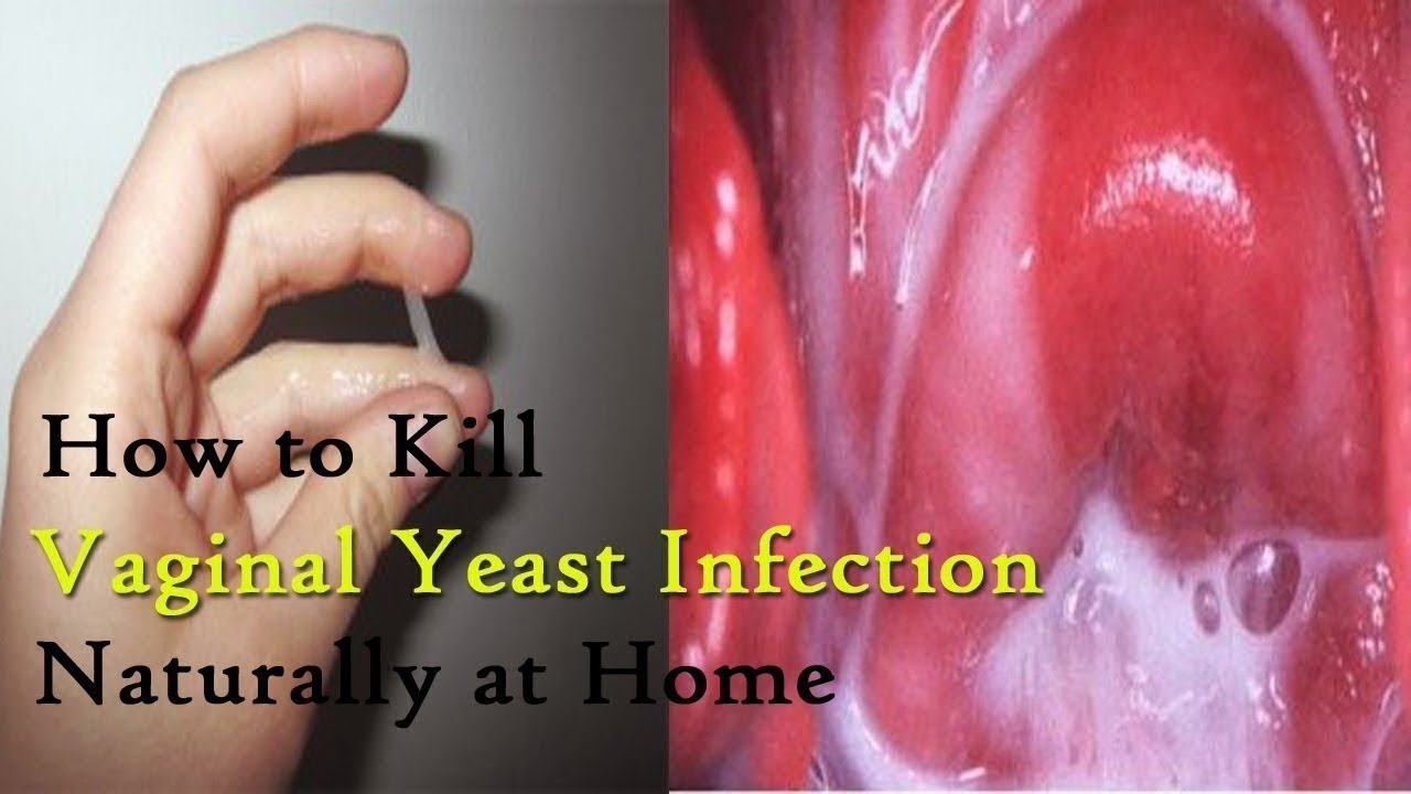 How To Cure Vaginal Yeast Infection With Coconut Oil -3942