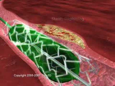 Medical Animation - Stent Procedure how a stent is used, 3d heart