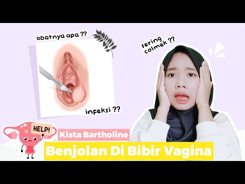 Fakta Kista Bartholin/Kista Bibir Vagina. Ini Cara Penyembuhannya I Risma Hrd ✨