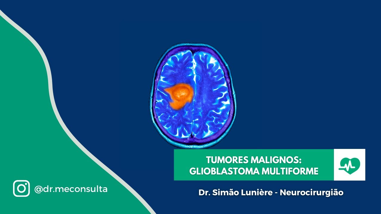 Tumor Cerebral Maligno: Glioblastoma Multiforme