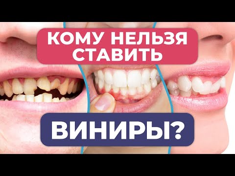 Нужно ли обтачивать зубы под виниры? / Мифы о винирах!