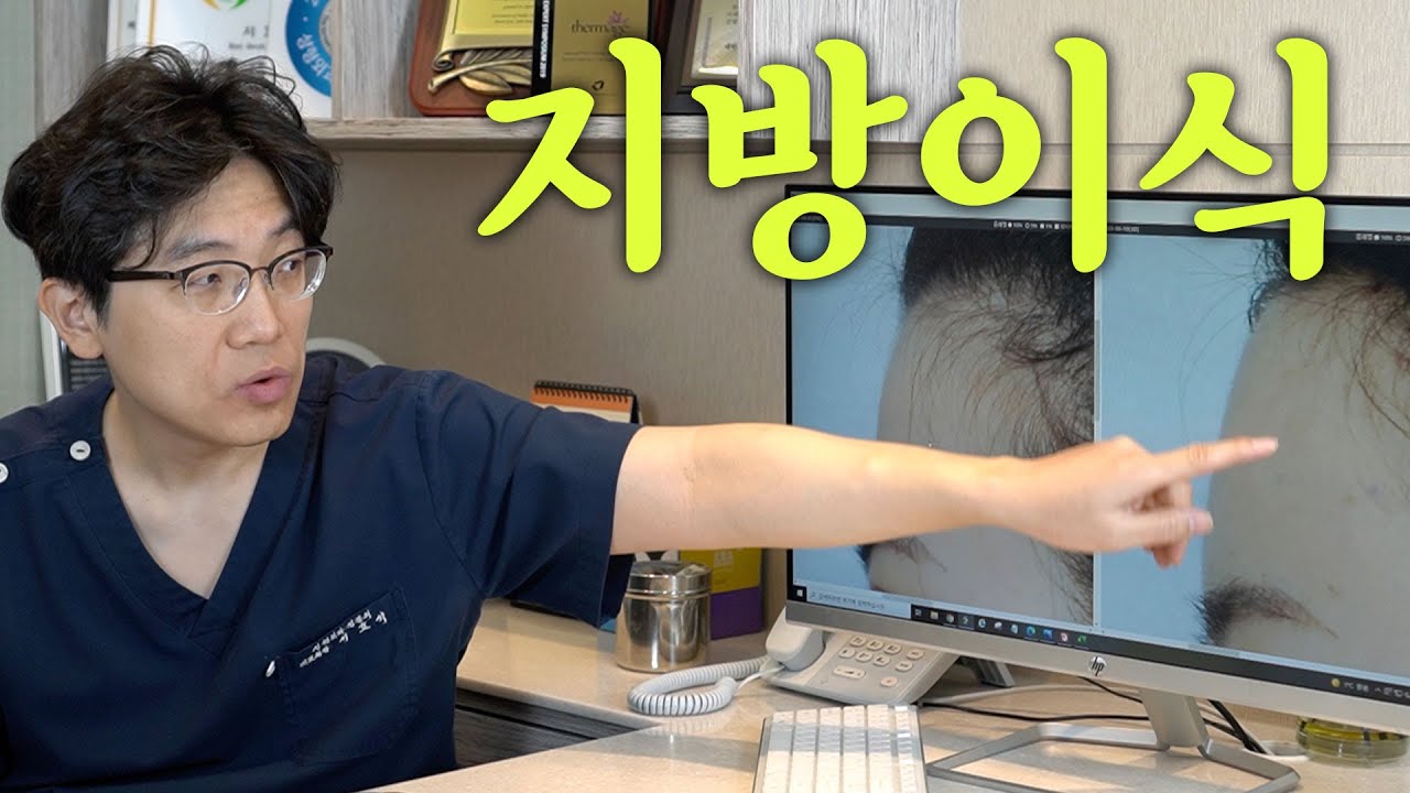 지방이식에 대한 모든 것 - 흔하게 하는 착각(지방이식2차,지방이식처짐,붓기,생착)