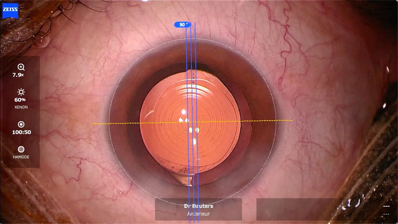 Unedited refractive lens exchange surgery (RLE) for presbyopia YouTube