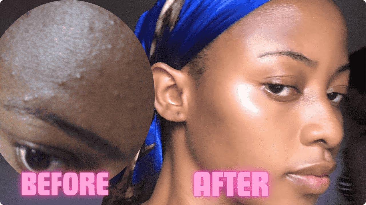 HOW I CLEARED MY ACNE IN TWO WEEKS |SIMPLE ROUTINE THAT ACTUALLY WORKS ...