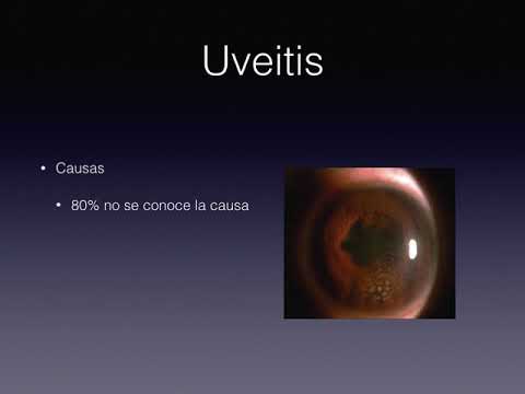 Uveitis en oftalmologia