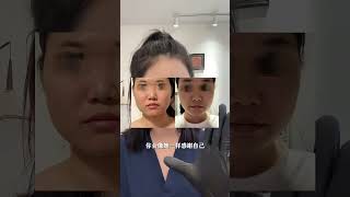 Adjustment ideas for deep overbite#Deep overbite#Posture#Face shape