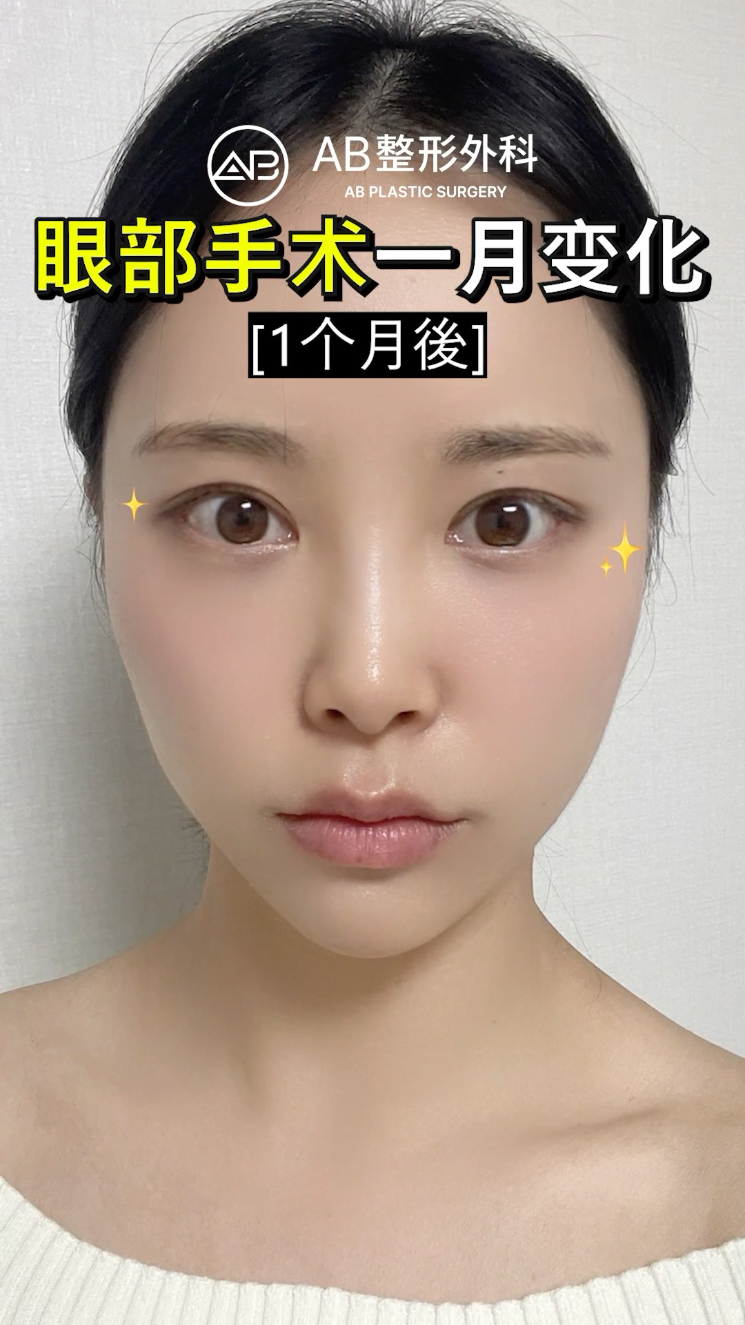 1個月紀錄：雙眼皮再手術的真實變化 #shorts
