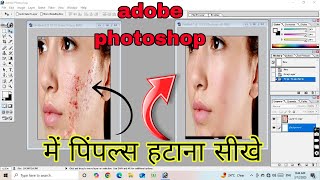 adobe photoshop me pimple kaise hataye | adobe photoshop 7.0