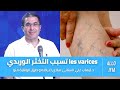 د إيهاب علي السناني Les Varices تسبب التخثر الوريدي و هاذي أعراضه و طرق الوقاية منو 