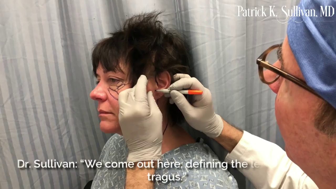 Planning Incisions for Facial Rejuvenation, Part III | Dr Patrick K Sullivan