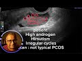Type B PCOS