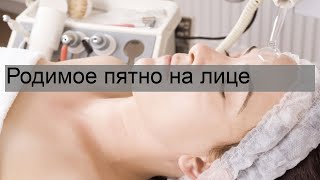 Родимое пятно на лице