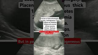 #Placentomegaly#placentation#causes#obstetric#reproduction#pregnancy#pregnancytips#2025#ytshorts
