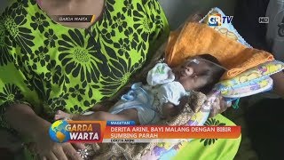 MAGETAN - Derita Arini, Bayi Malang Dengan Bibir Sumbing Parah
