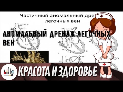 Аномальный дренаж легочных вен