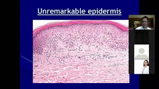 Lecture-2: Dermatopathology; Lichenoid and Interface Dermatitis
