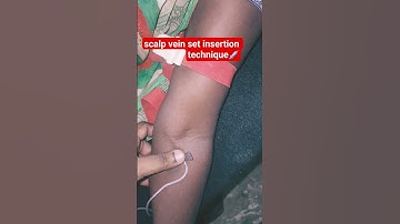 scalp vein set insertion technique💉😱