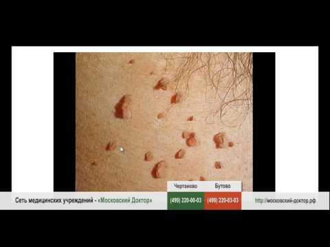 Папилломы на шее