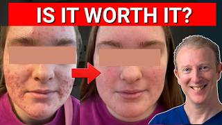 Isotretinoin Roaccutane Explained The Most Powerful Acne Treatment