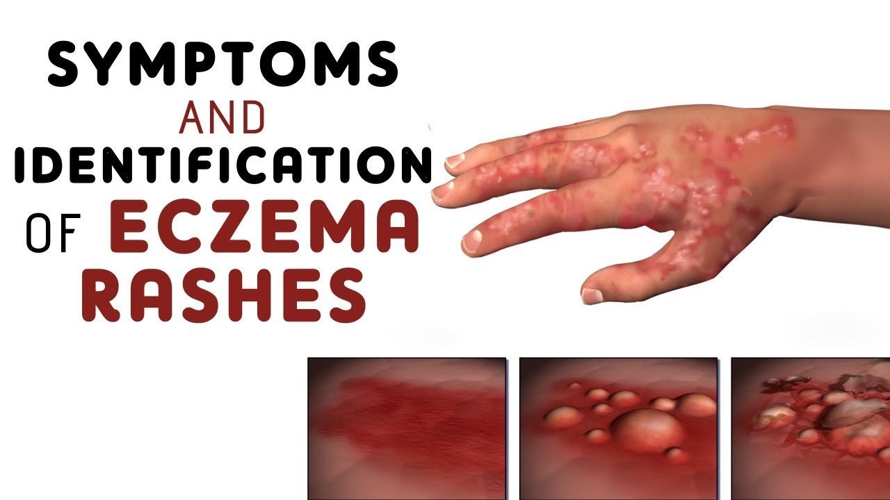 Symptoms And Identification Of Different Types Of Eczema Rashes Youtube