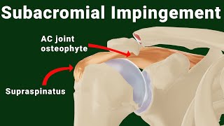Subacromial impingement of the shoulder (animated)